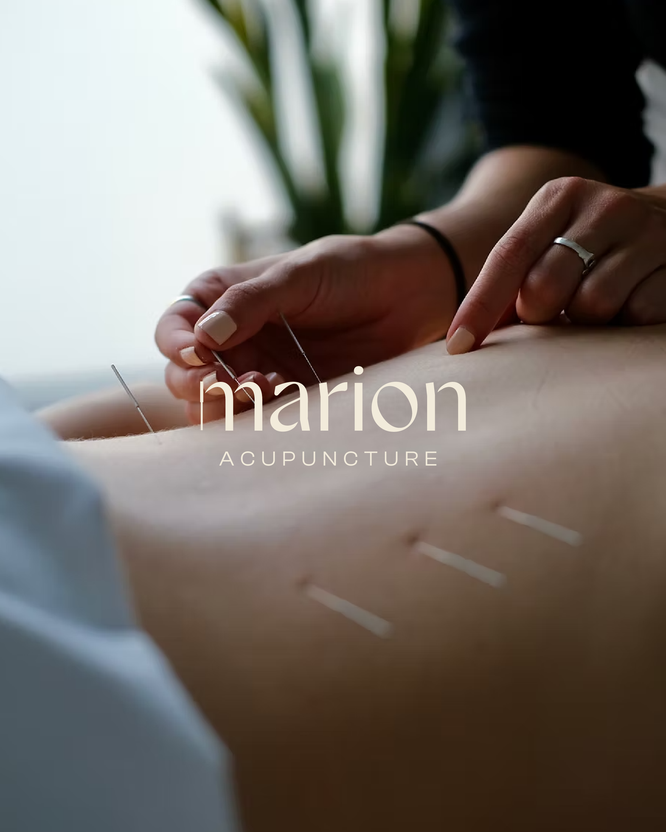 Marion acupuncture par Valfeltõ