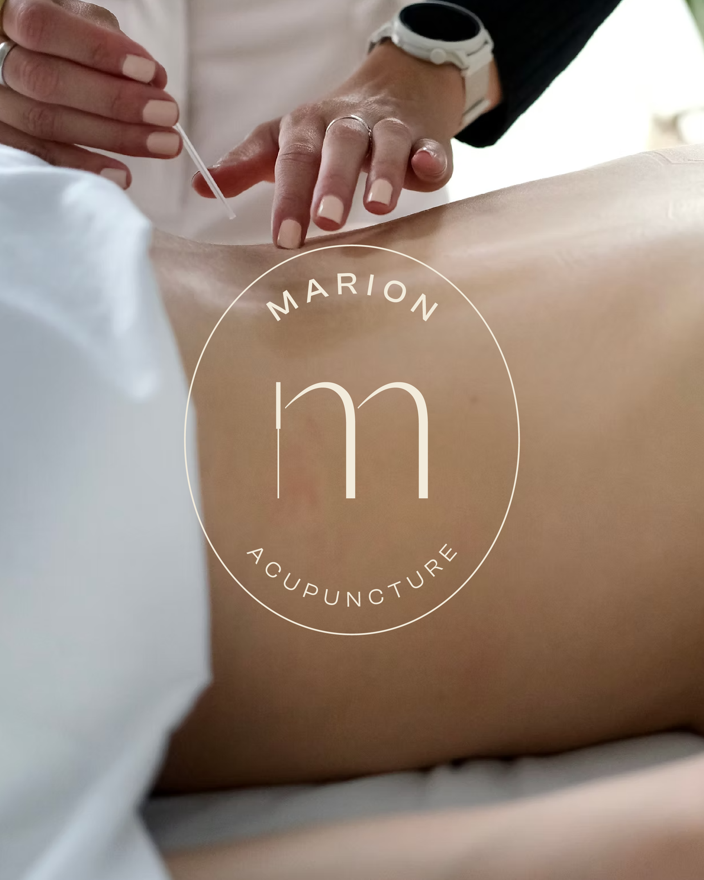 Marion acupuncture par Valfeltõ